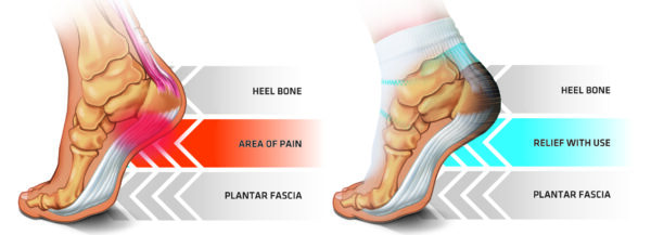 Plantar Fasciitis